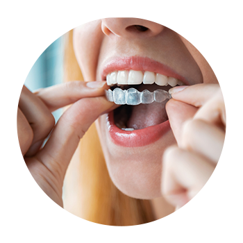 Invisalign Aligner